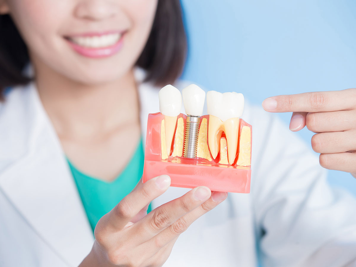implantes dentales unitarios