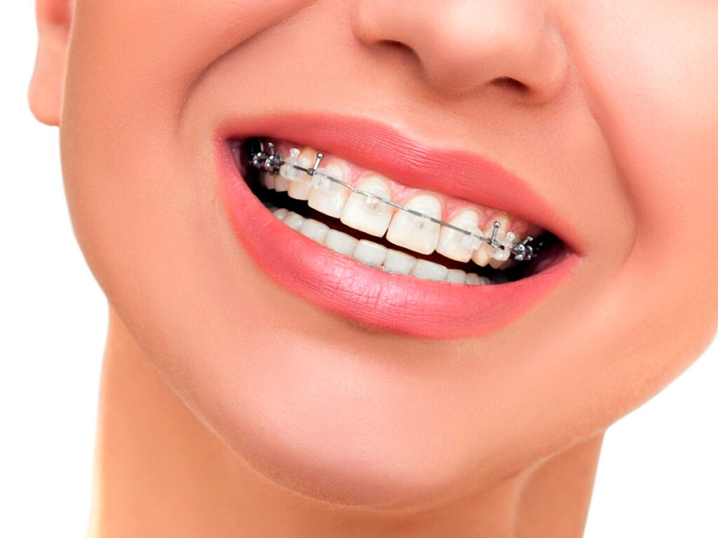 Brackets metálicos y estéticos la solución para tu sonrisa ideal