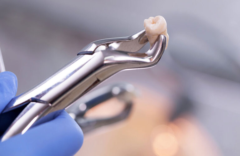 extraccion dental endodoncia